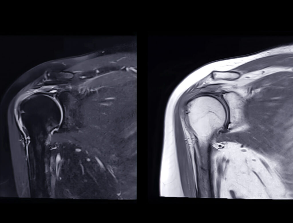 MRI of Shoulder Joint